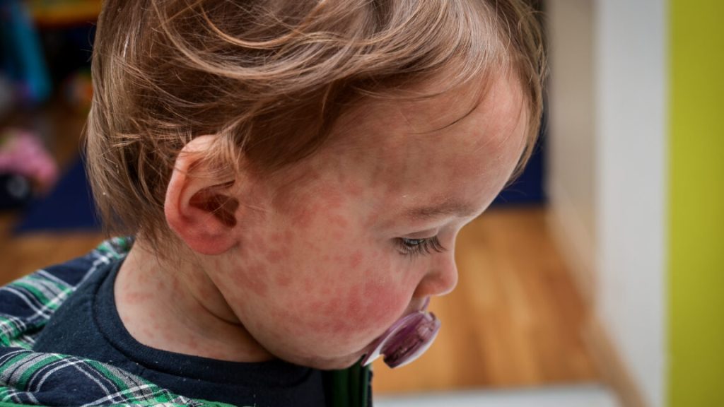 Nine unvaccinated people hospitalized as Texas measles outbreak doubles